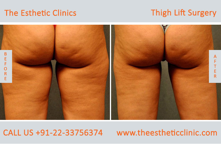 Thigh Lift Surgery, Thigh Reduction before after photos in mumbai india (6)